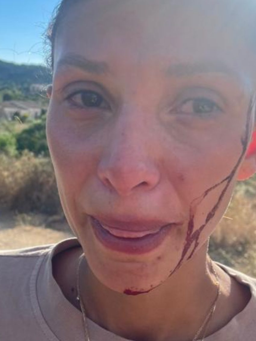 Can Yaman’ın DJ sevgilisi Sara Bluma yüzü kanlı fotoğrafı paylaştı ve kadına şiddeteisyan etti